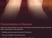 Hallux Valgus (Bunions): Causes, Characteristics Treatment