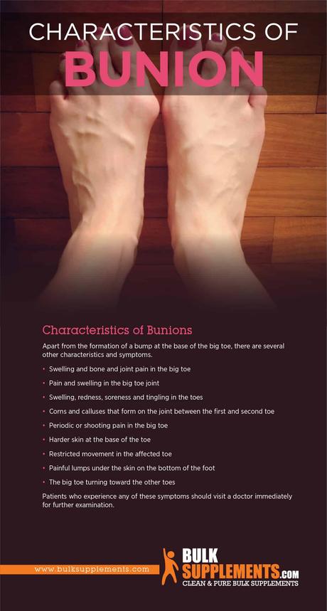 Characteristics of Bunion