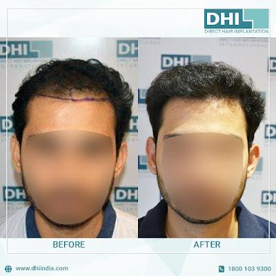 Want to Get a Makeover with a Hair Transplant in Chandigarh?