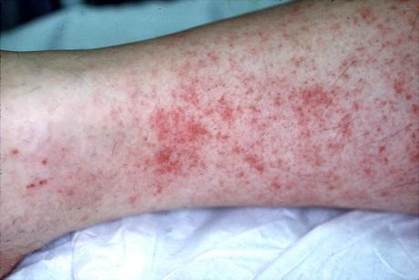 AYURVEDIC TREATMENT OF ROCKY MOUNTAIN SPOTTED FEVER (RMSF)