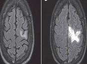 Treatment Progressive Multifocal Leukoencephalopathy (JC-Virus)