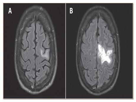 Treatment For Progressive Multifocal Leukoencephalopathy (JC-Virus)