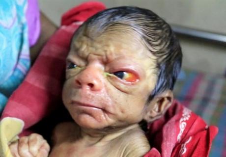 Bangladesh: un bébé est né avec l’apparence d’un vieil homme de 85 ans ! (Vidéo)