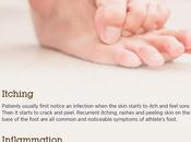 Tinea Pedis (Athlete’s Foot): Causes, Symptoms Treatment