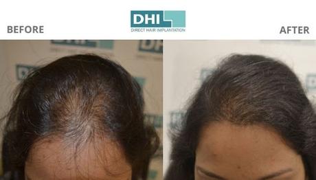 Hair Transplant in Chennai - DHI India