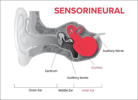 Herbal Remedy For Sensorineural Hearing Loss