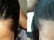 Hair Transplant Kolkata India