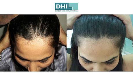 Hair Transplant in Kolkata – DHI India