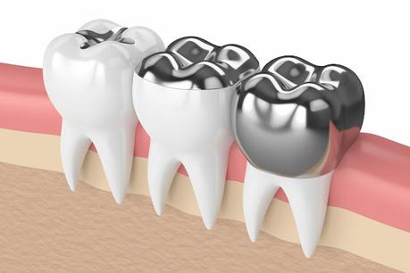 Dental Filling Material Market is Booming with at Highest CAGR in the Upcoming period of 2021 to 2026 Dental Filling Material Market is Booming with at Highest CAGR in the Upcoming period of 2021 to 2026