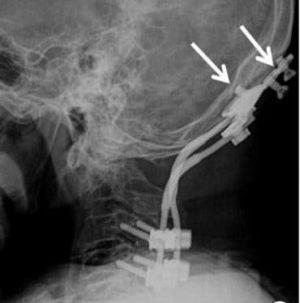 cerviccal fusion of patient with Craniocervical Instability Ehlers Danlos Syndrome 