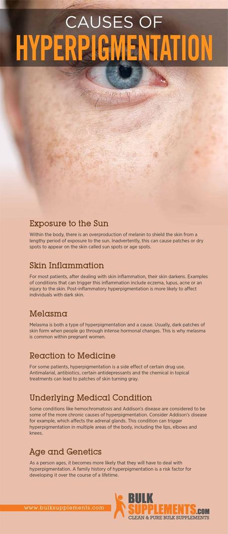 Causes of Hyperpigmentation