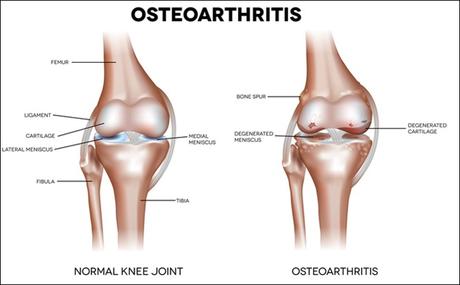 Natural Cure For Osteoarthritis