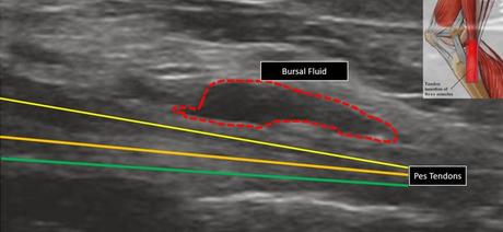 Pes Anserine Bursitis