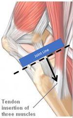 Pes Anserine Bursitis