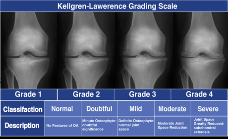 Arthritis in Knee? Here’s What to Know