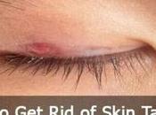 Skin Tags Eyelids Remove Eyelid Causes