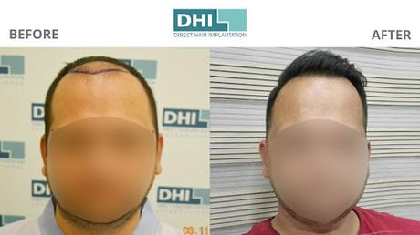 Is Hair Transplant Safe And Permanent?