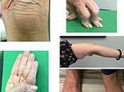 Ayurvedic Treatment Ehlers Danlos Syndrome