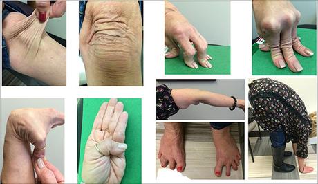 Ayurvedic Treatment For Ehlers Danlos Syndrome