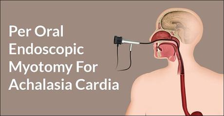 Natural Cure For Achalasia Cardia