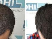 Perfect Limit Hair Transplant Guwahati India