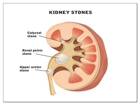 AYURVEDIC ASPECT OF RENAL CALCULI