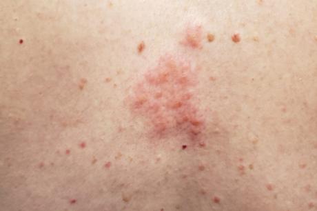 my experience with shingles