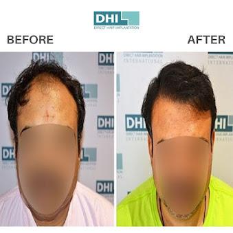 Hair Transplant Cost in Guwahati – DHI India