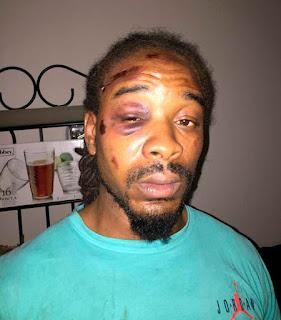 Police in suburban St. Louis, MO, beat black motorist for allegedly failing to use a turn signal -- leaving him with a broken nose and black eye, leading to lawsuit