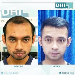 What Makes DHI A Popular Place For Hair Transplant in Lucknow?