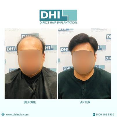 Hair transplant - A permanent solution for hair loss