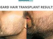 Much Does Beard Transplant Guwahati Costs?