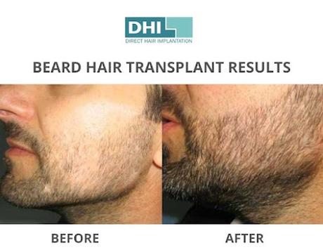 How much does a beard transplant in Guwahati costs?