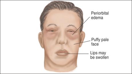 Herbal Remedies For Nephrotic Syndrome