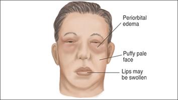 Herbal Remedies For Nephrotic Syndrome