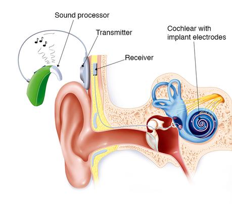The Cochlear Implant Experience