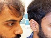 Cheapest Hair Transplant Cost Jaipur India