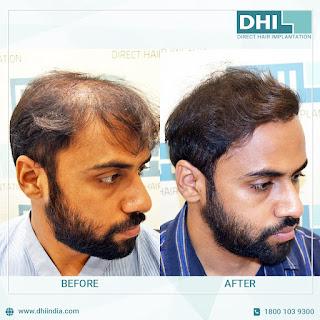 Cheapest Hair Transplant Cost in Jaipur | DHI India Cheapest Hair Transplant Cost in Jaipur | DHI India