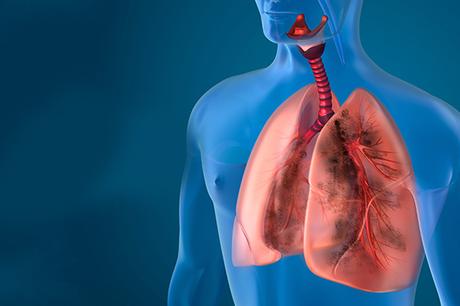 What is Honeycombing in the Lungs? (Pulmonary Fibrosis)-Causes and Treatment