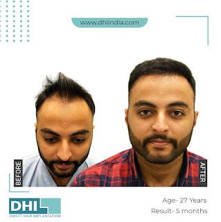 What Makes DHI A Popular Place For Hair Transplant in Jaipur?