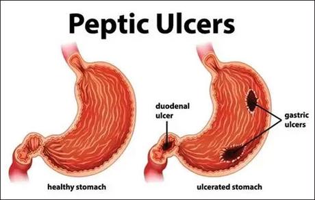 Duodenal ulcers and Special Ayurvedic Care Packages