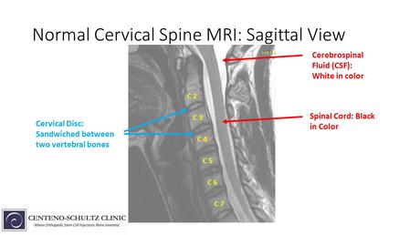 normal vs abnormal Cervical MRI