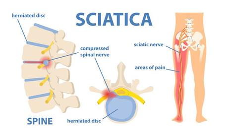 What is Sciatica?