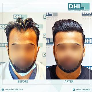 Hair Transplant in Chennai Hair Transplant in Chennai