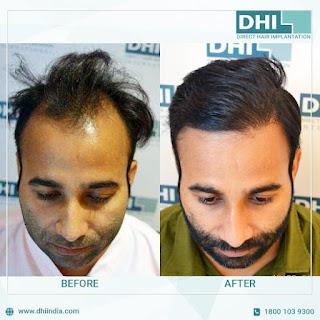 Hair Transplant Clinic in Chennai Hair Transplant Clinic in Chennai