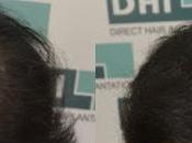 Looking Best Hair Transplant Kolkata?