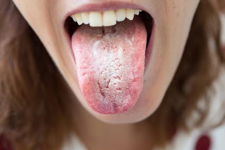 Candidiasis is a fungus infection caused by the Candida yeast (a type of fungus).