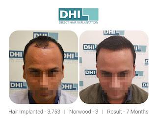 Choose the best hair transplant surgeon in Chandigarh for guaranteed results