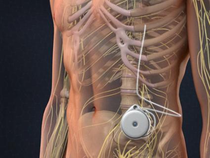 Intrathecal Pumps Market 2021-2026: Research Report Size, Share And Trends In 2020, the global intrathecal pumps market was valued at USD 189.7 million, with a compound yearly growth rate (CAGR) of 5.1 percent predicted from 2021 to 2028.