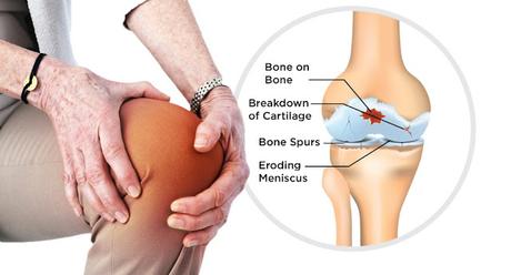 Osteoarthritis Treatment Includes Several Medicinal and Non-Medicinal Methods, Including Drugs and Exercises